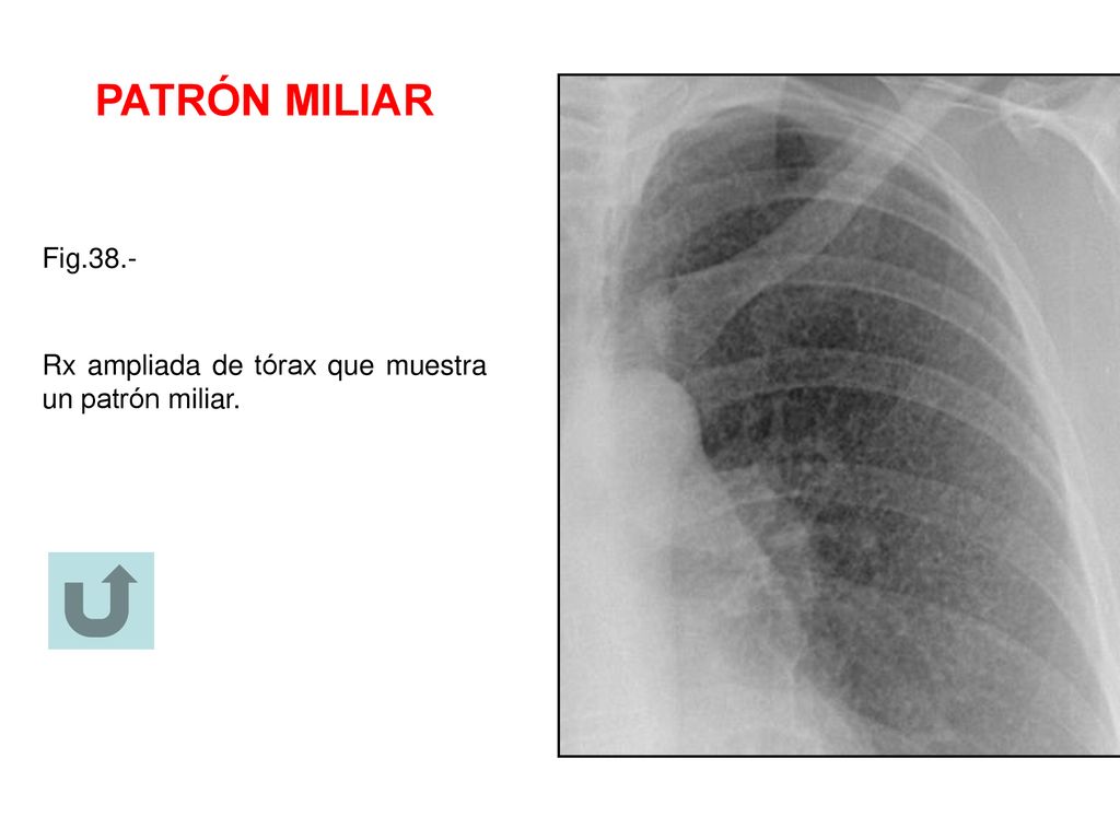 PATRÓN MILIAR Fig.38.- Rx ampliada de tórax que muestra un patrón miliar.