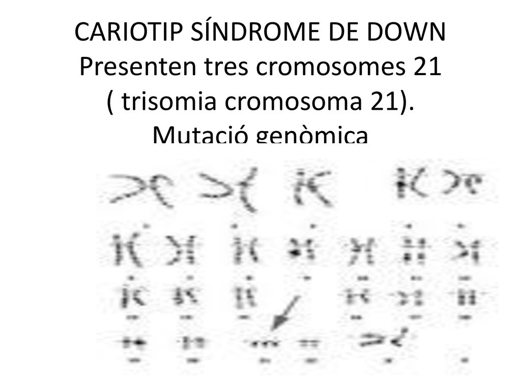 CARIOTIP SÍNDROME DE DOWN Presenten tres cromosomes 21 ( trisomia cromosoma 21). Mutació genòmica