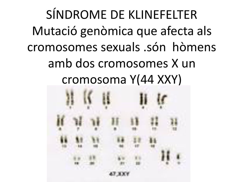 SÍNDROME DE KLINEFELTER Mutació genòmica que afecta als cromosomes sexuals .són hòmens amb dos cromosomes X un cromosoma Y(44 XXY)