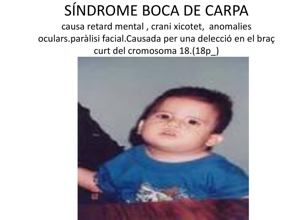SÍNDROME BOCA DE CARPA causa retard mental , crani xicotet, anomalies oculars.paràlisi facial.Causada per una delecció en el braç curt del cromosoma 18.(18p_)