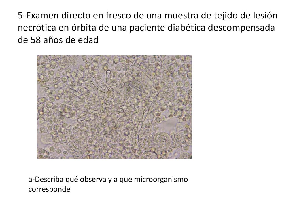 5-Examen directo en fresco de una muestra de tejido de lesión necrótica en órbita de una paciente diabética descompensada de 58 años de edad