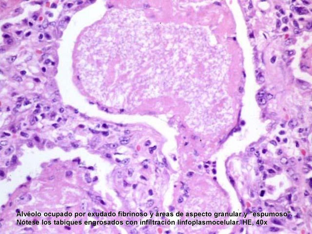 Alvéolo ocupado por exudado fibrinoso y áreas de aspecto granular y espumoso .