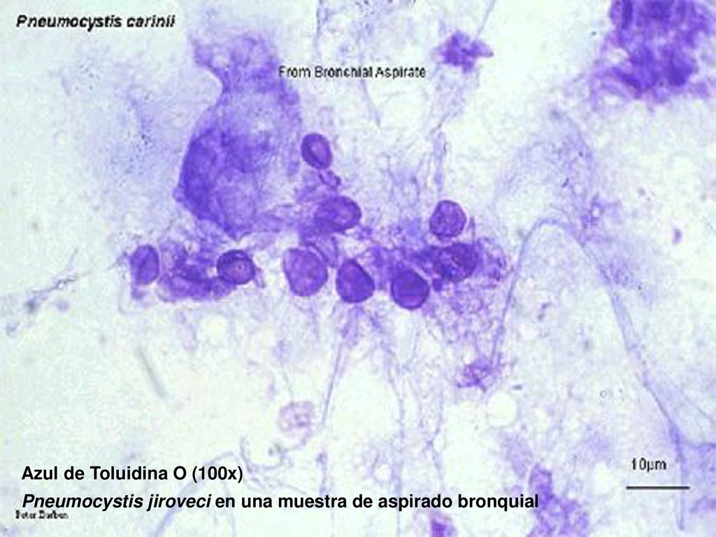 Azul de Toluidina O (100x) Pneumocystis jiroveci en una muestra de aspirado bronquial