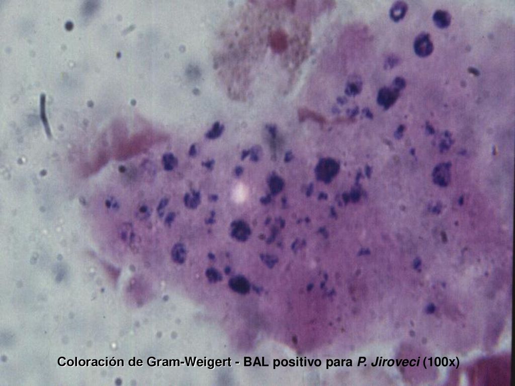 Coloración de Gram-Weigert - BAL positivo para P. Jiroveci (100x)