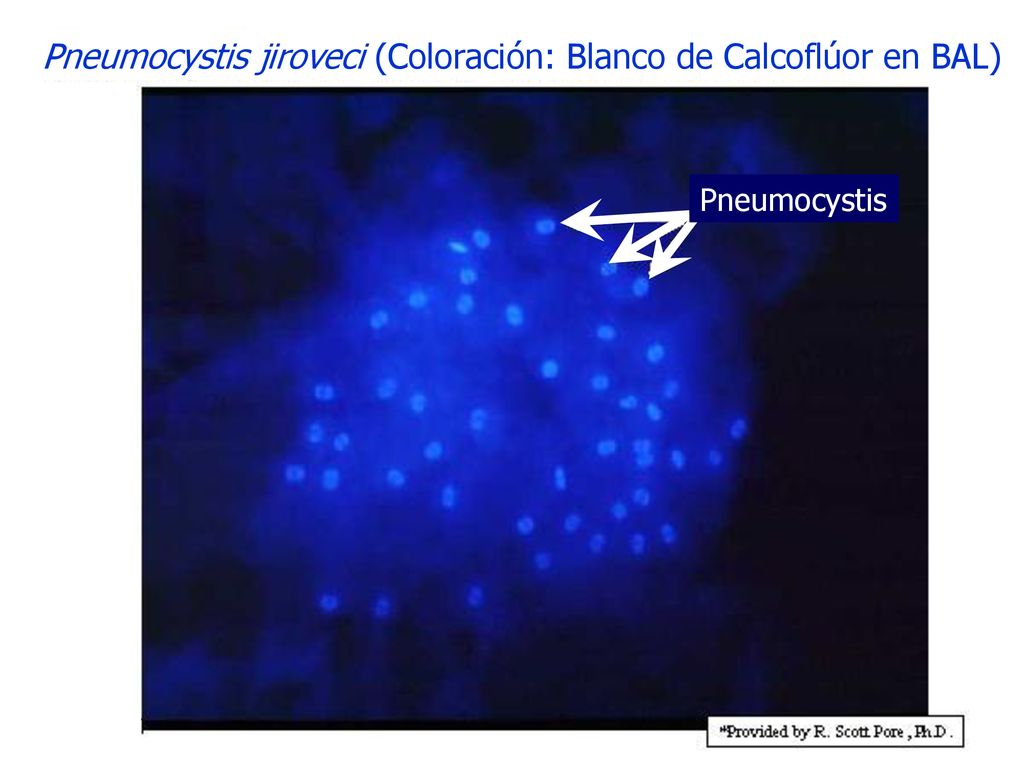Pneumocystis jiroveci (Coloración: Blanco de Calcoflúor en BAL)