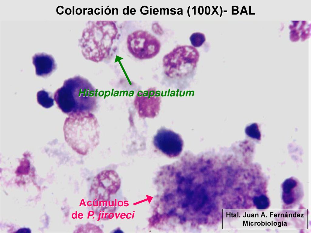 Coloración de Giemsa (100X)- BAL Histoplama capsulatum