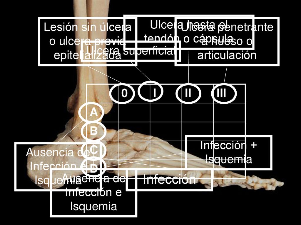 Infección Ulcera hasta el tendón o cápsula Lesión sin úlcera