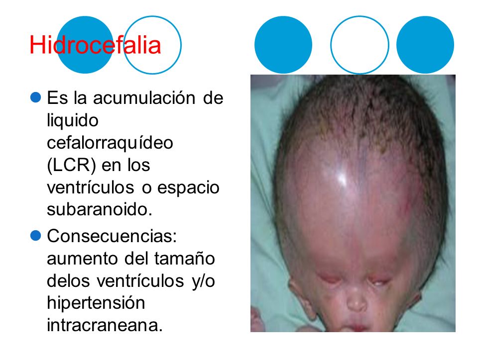 Hidrocefalia Es la acumulación de liquido cefalorraquídeo (LCR) en los ventrículos o espacio subaranoido.