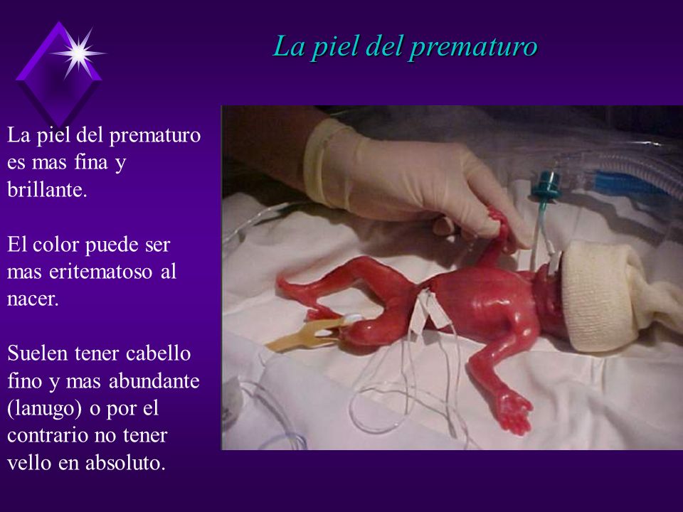 La piel del prematuro La piel del prematuro es mas fina y brillante.