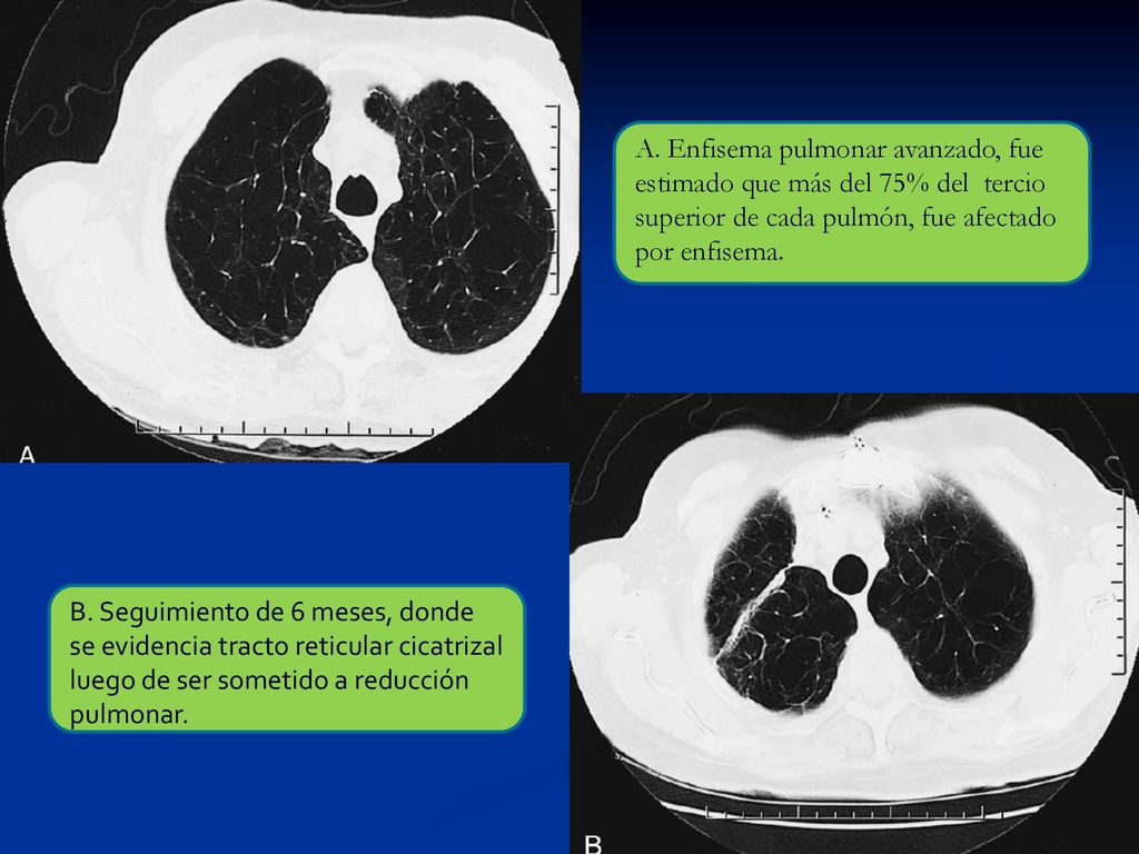 A. Enfisema pulmonar avanzado, fue estimado que más del 75% del tercio superior de cada pulmón, fue afectado por enfisema.
