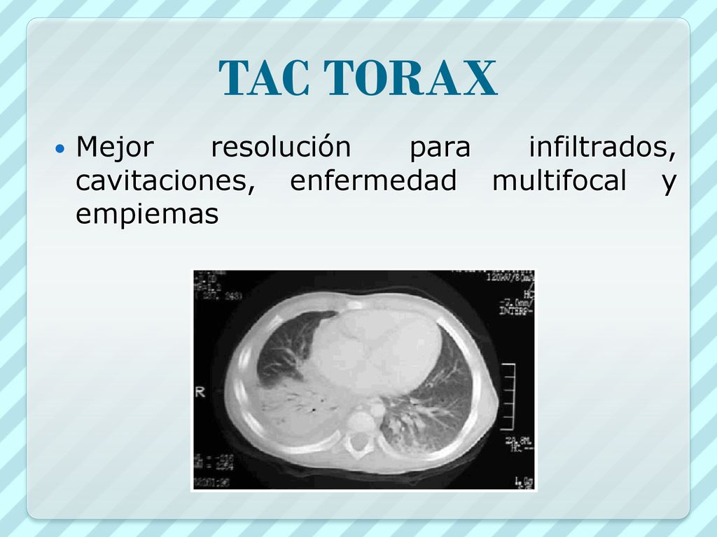 TAC TORAX Mejor resolución para infiltrados, cavitaciones, enfermedad multifocal y empiemas