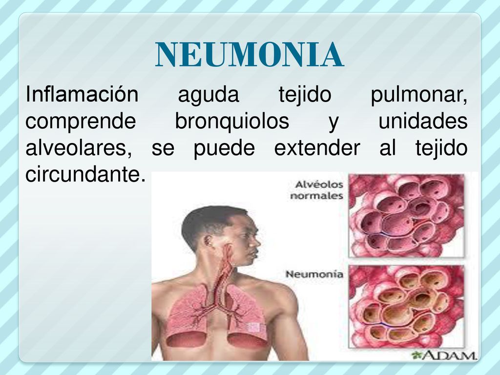 NEUMONIA Inflamación aguda tejido pulmonar, comprende bronquiolos y unidades alveolares, se puede extender al tejido circundante.