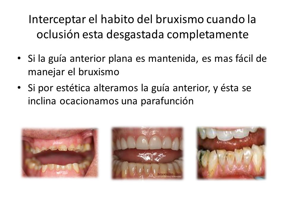 Interceptar el habito del bruxismo cuando la oclusión esta desgastada completamente