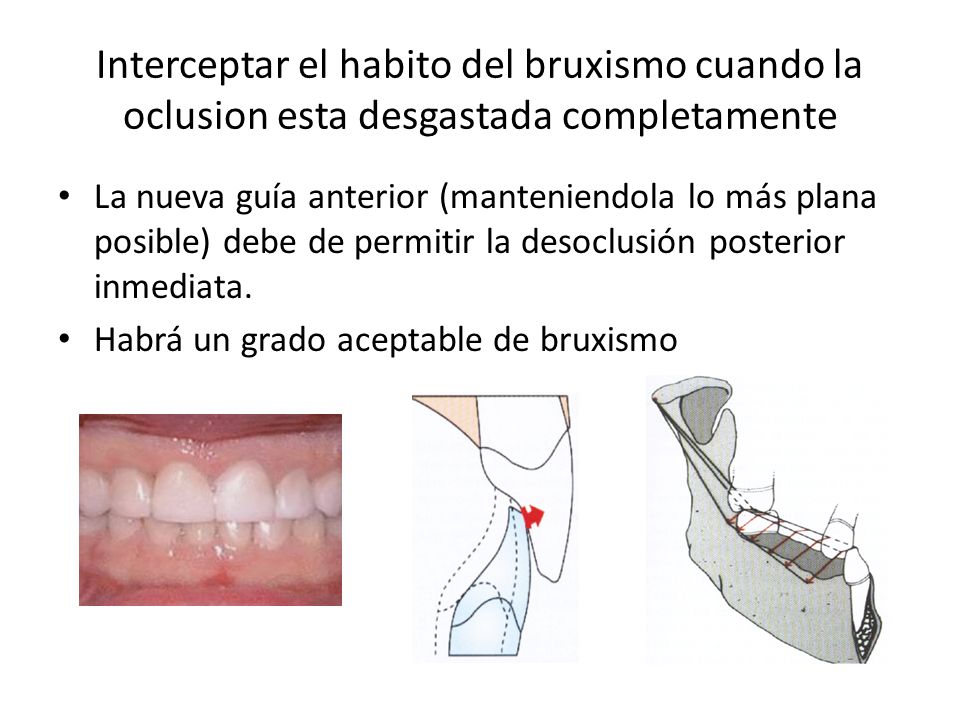 Interceptar el habito del bruxismo cuando la oclusion esta desgastada completamente