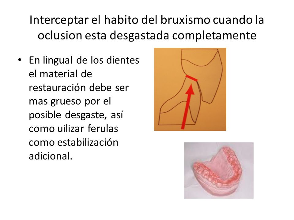 Interceptar el habito del bruxismo cuando la oclusion esta desgastada completamente