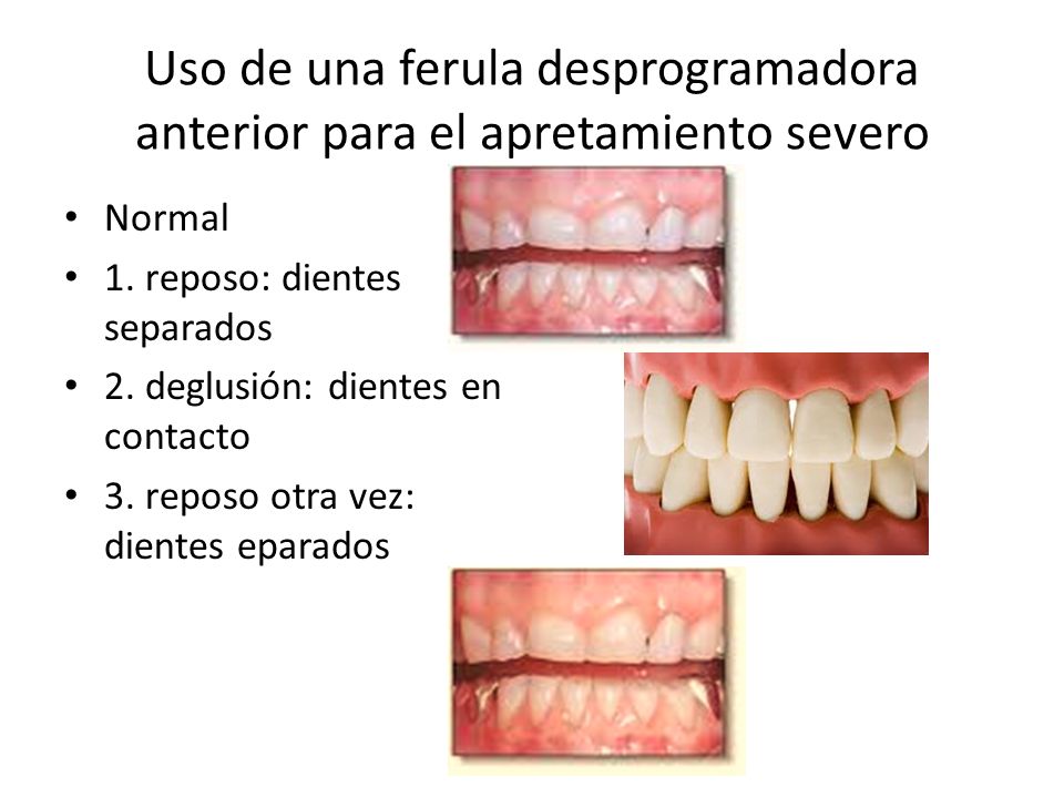 Uso de una ferula desprogramadora anterior para el apretamiento severo