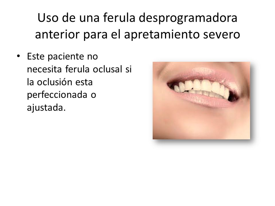 Uso de una ferula desprogramadora anterior para el apretamiento severo