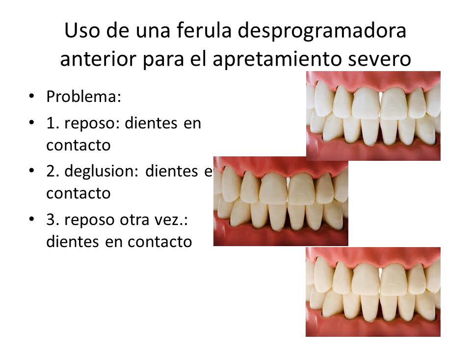 Uso de una ferula desprogramadora anterior para el apretamiento severo