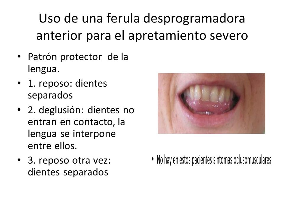 Uso de una ferula desprogramadora anterior para el apretamiento severo