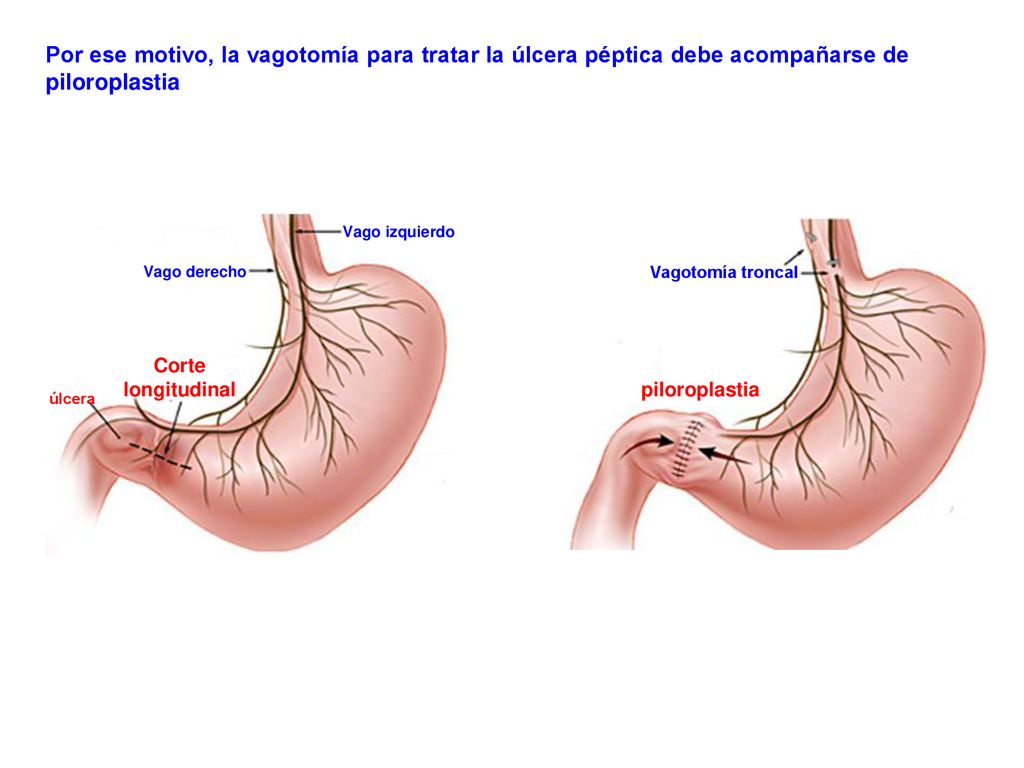 Por ese motivo, la vagotomía para tratar la úlcera péptica debe acompañarse de piloroplastia
