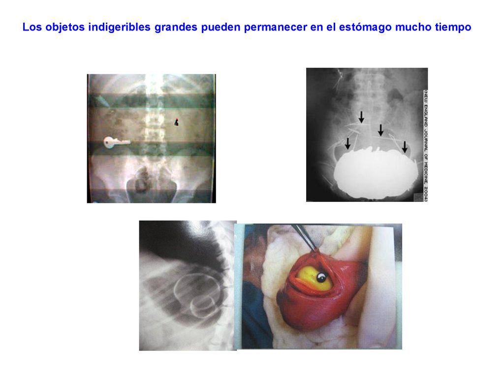 Los objetos indigeribles grandes pueden permanecer en el estómago mucho tiempo