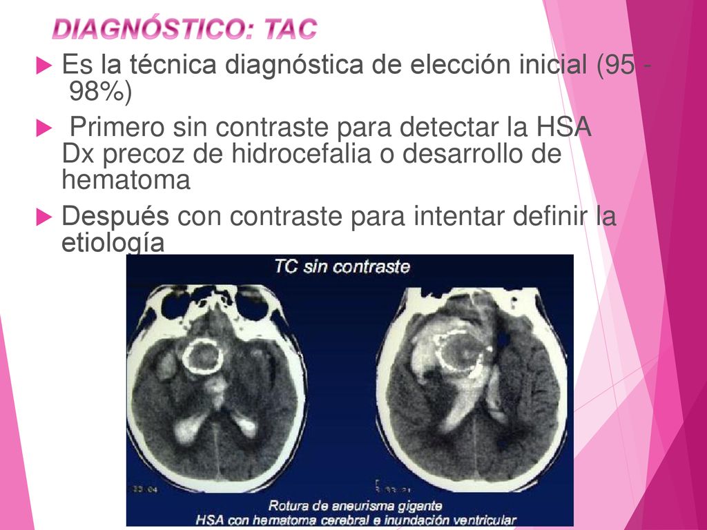 DIAGNÓSTICO: TAC Es la técnica diagnóstica de elección inicial ( %)