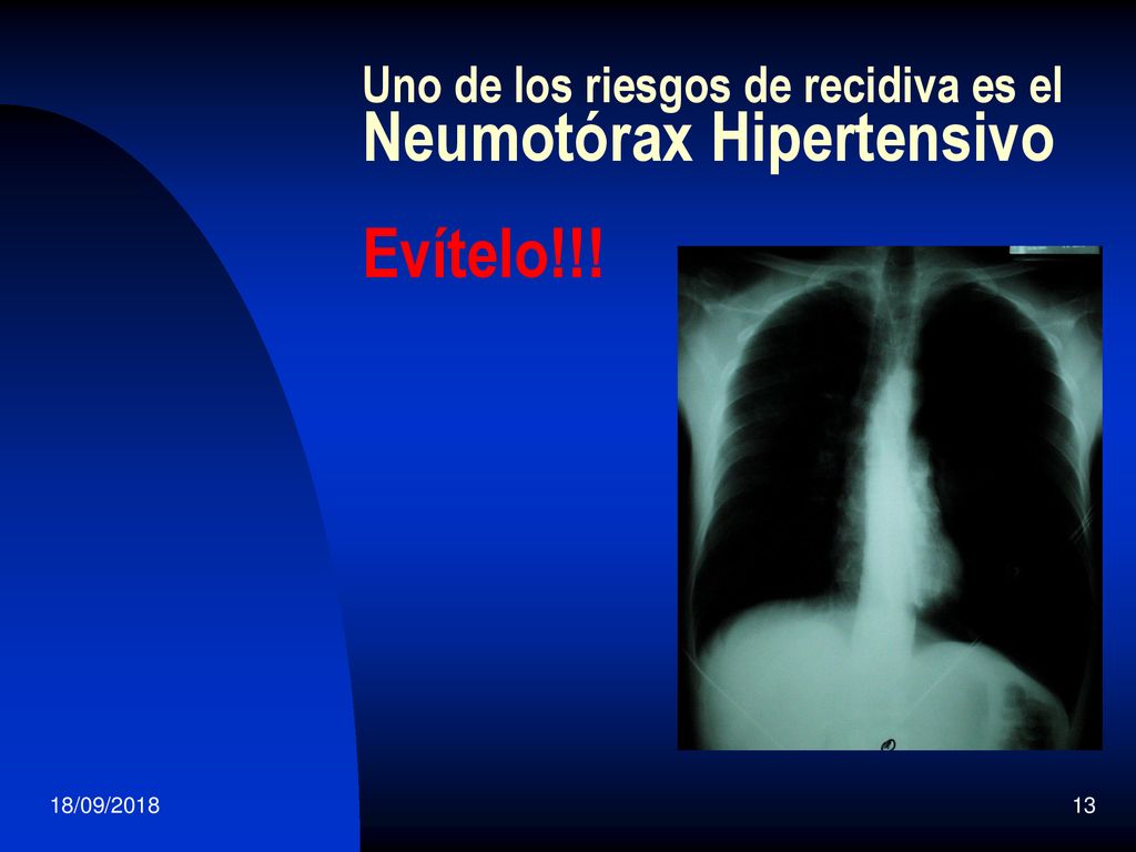 Uno de los riesgos de recidiva es el Neumotórax Hipertensivo Evítelo!!!