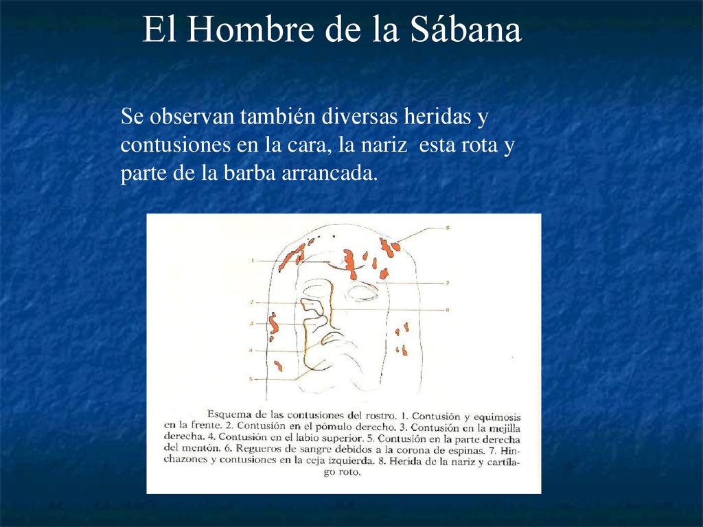 El Hombre de la Sábana Se observan también diversas heridas y contusiones en la cara, la nariz esta rota y parte de la barba arrancada.