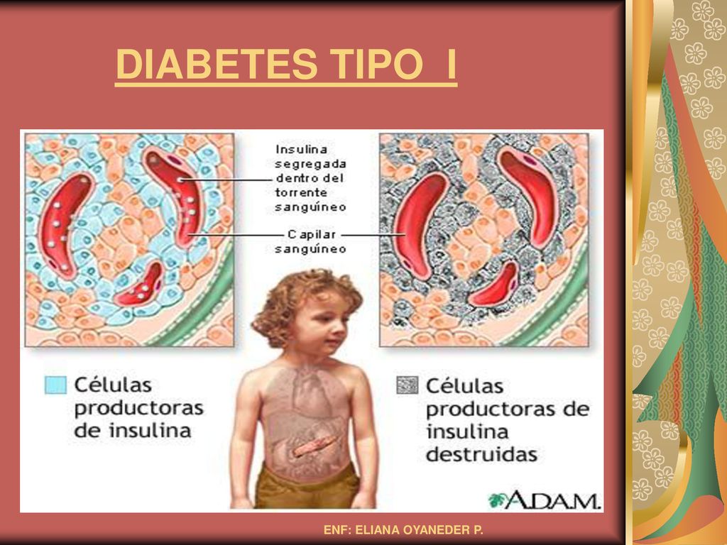 DIABETES TIPO I ENF: ELIANA OYANEDER P.