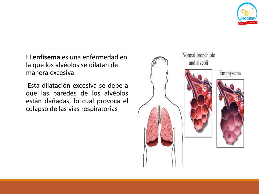 El enfisema es una enfermedad en la que los alvéolos se dilatan de manera excesiva