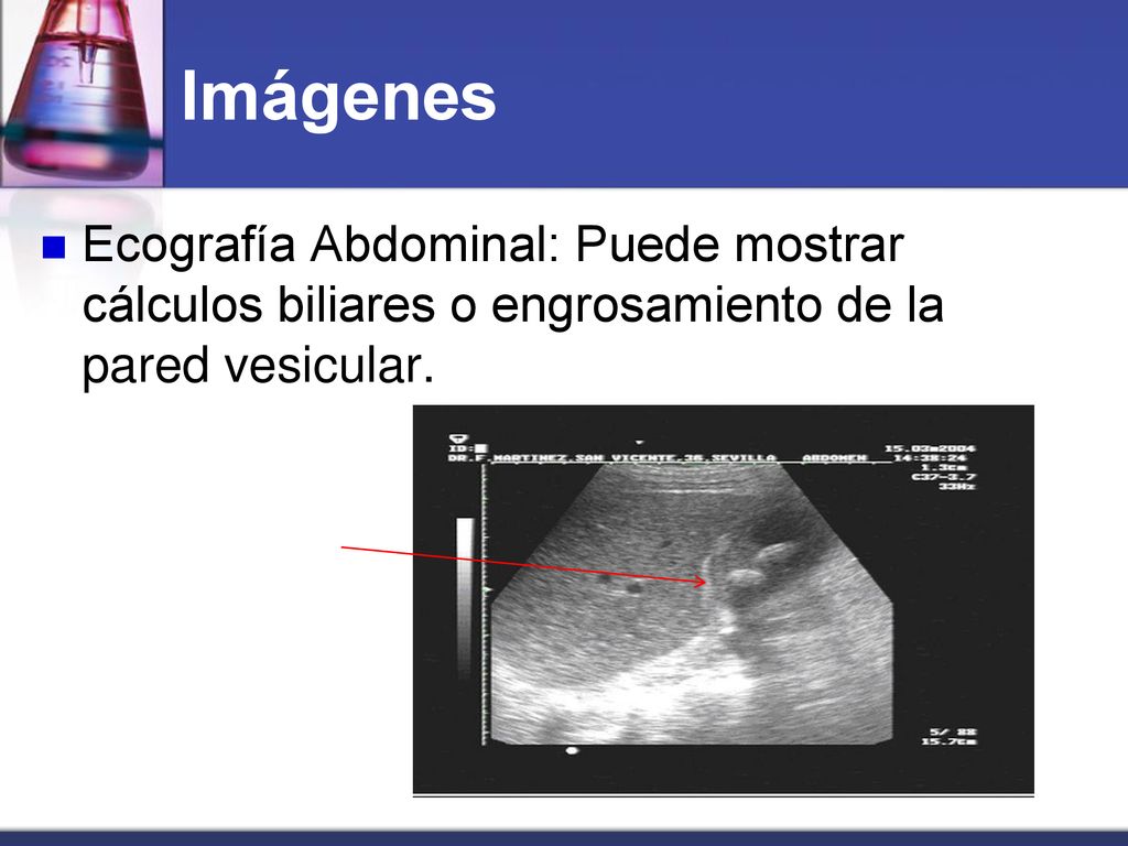 Imágenes Ecografía Abdominal: Puede mostrar cálculos biliares o engrosamiento de la pared vesicular.