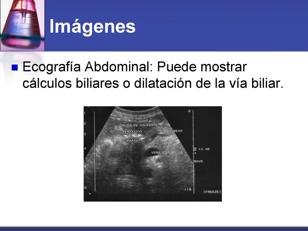 Imágenes Ecografía Abdominal: Puede mostrar cálculos biliares o dilatación de la vía biliar.