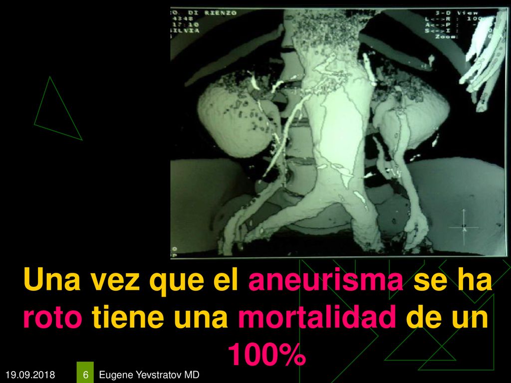 Una vez que el aneurisma se ha roto tiene una mortalidad de un 100%