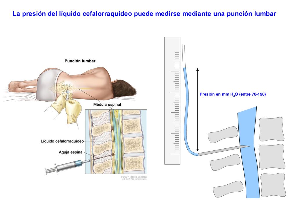 La presión del líquido cefalorraquídeo puede medirse mediante una punción lumbar