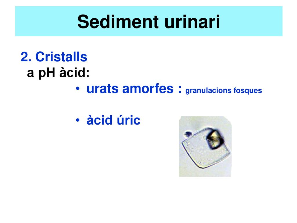 Sediment urinari a pH àcid: urats amorfes : granulacions fosques