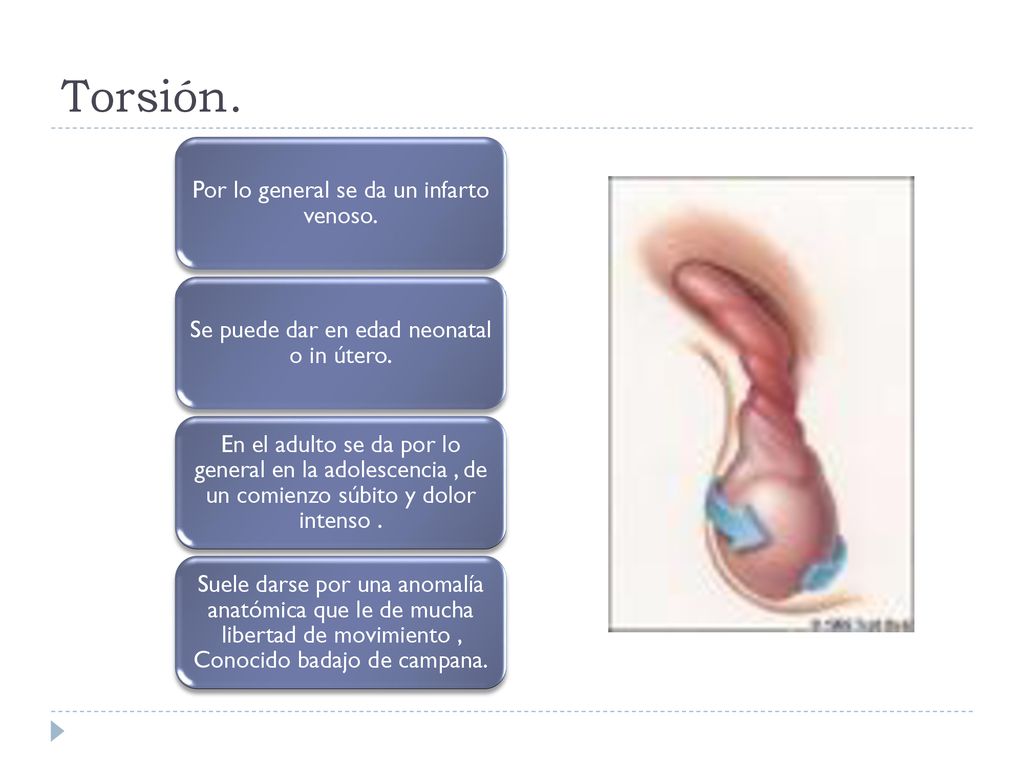Torsión. Por lo general se da un infarto venoso.