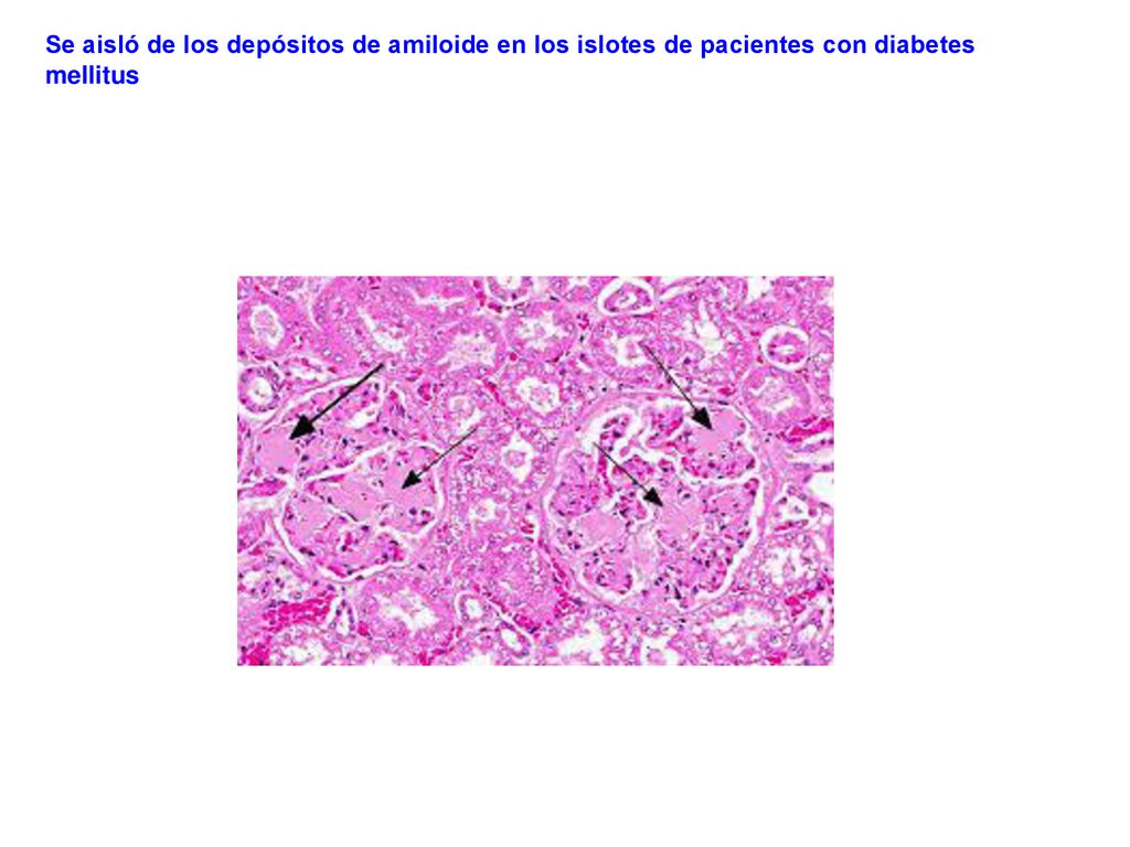 Se aisló de los depósitos de amiloide en los islotes de pacientes con diabetes mellitus