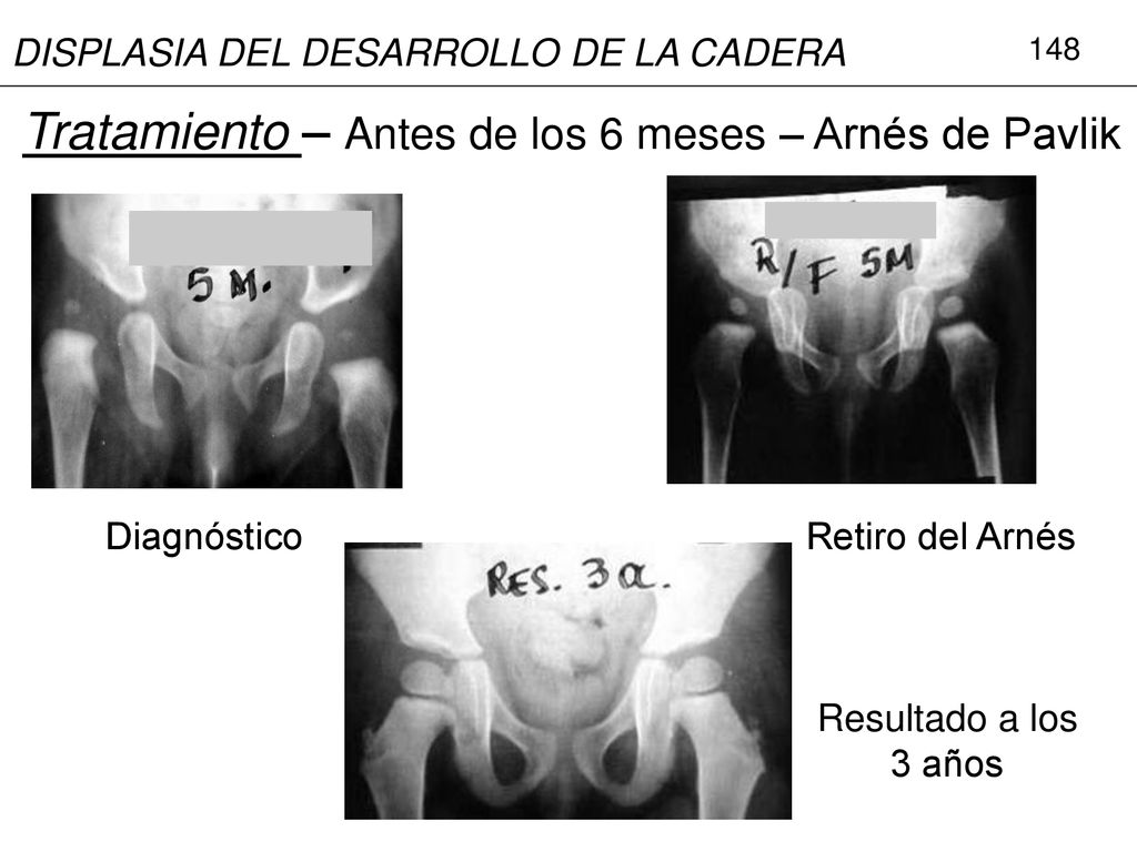 Tratamiento – Antes de los 6 meses – Arnés de Pavlik