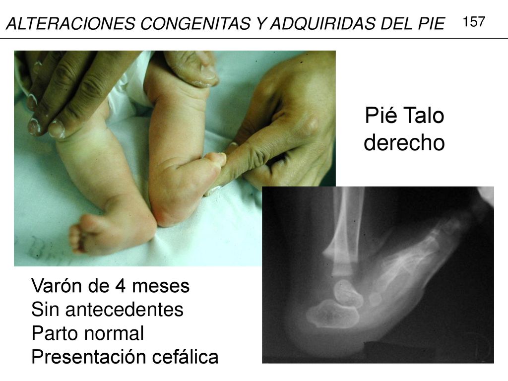 Pié Talo derecho Varón de 4 meses Sin antecedentes Parto normal