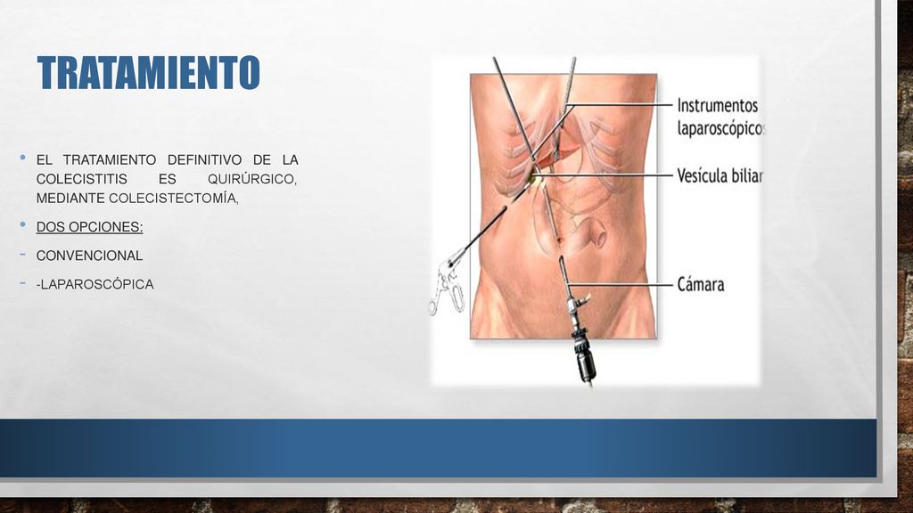 Tratamiento El tratamiento definitivo de la colecistitis es quirúrgico, mediante colecistectomía,