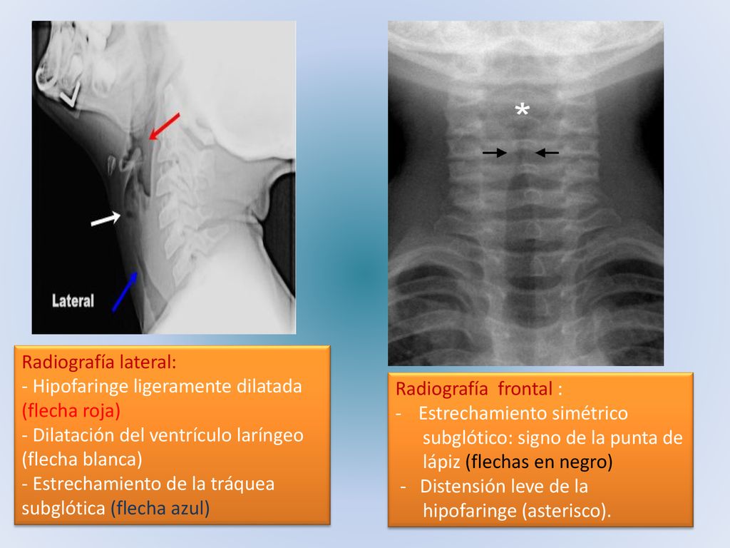 Radiografía lateral: - Hipofaringe ligeramente dilatada (flecha roja) - Dilatación del ventrículo laríngeo (flecha blanca)
