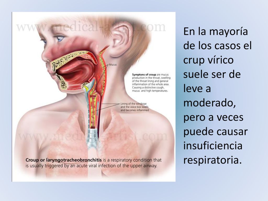 En la mayoría de los casos el crup vírico suele ser de leve a moderado, pero a veces puede causar insuficiencia