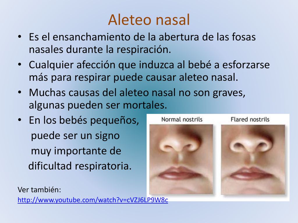 Aleteo nasal Es el ensanchamiento de la abertura de las fosas nasales durante la respiración.