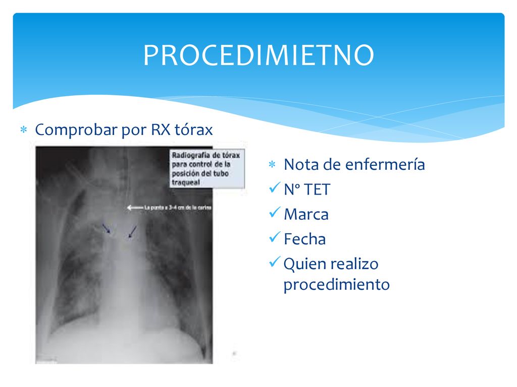PROCEDIMIETNO Comprobar por RX tórax Nota de enfermería Nº TET Marca