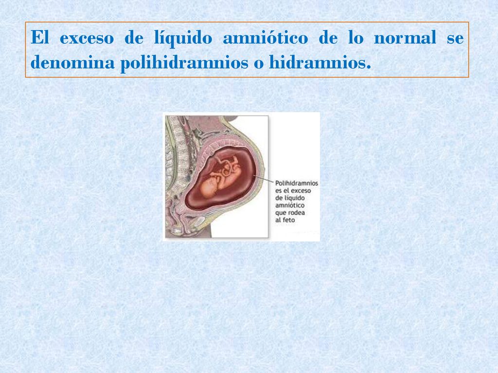 El exceso de líquido amniótico de lo normal se denomina polihidramnios o hidramnios.