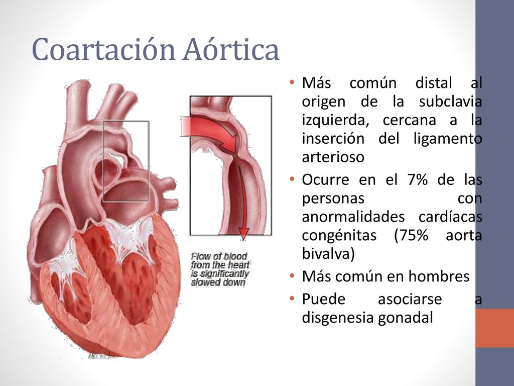 Coartación Aórtica Más común distal al origen de la subclavia izquierda, cercana a la inserción del ligamento arterioso.