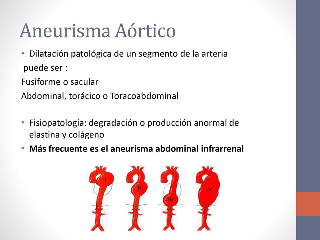 Aneurisma Aórtico Dilatación patológica de un segmento de la arteria