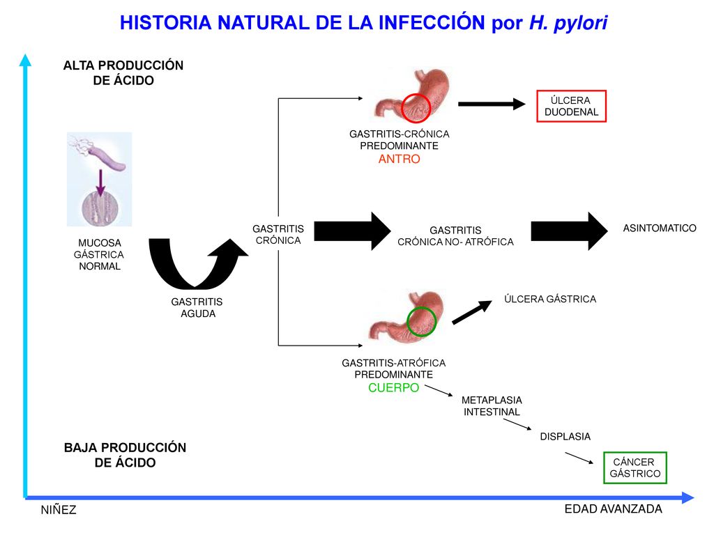 HISTORIA NATURAL DE LA INFECCIÓN por H. pylori