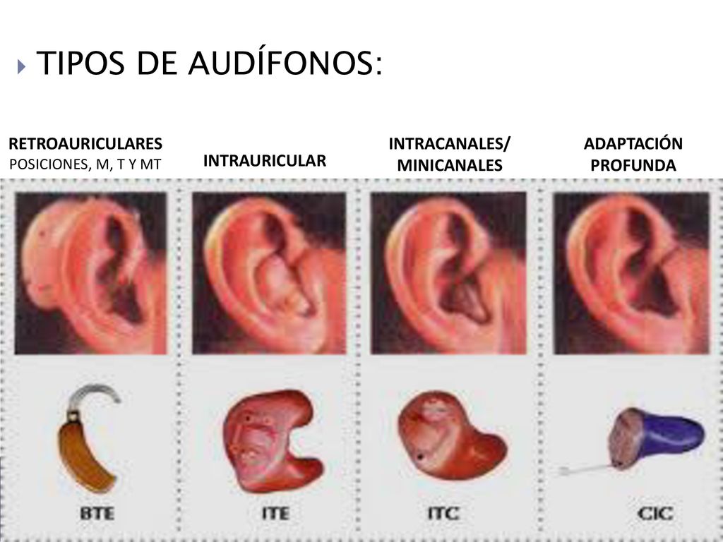 TIPOS DE AUDÍFONOS: RETROAURICULARES INTRACANALES/ MINICANALES