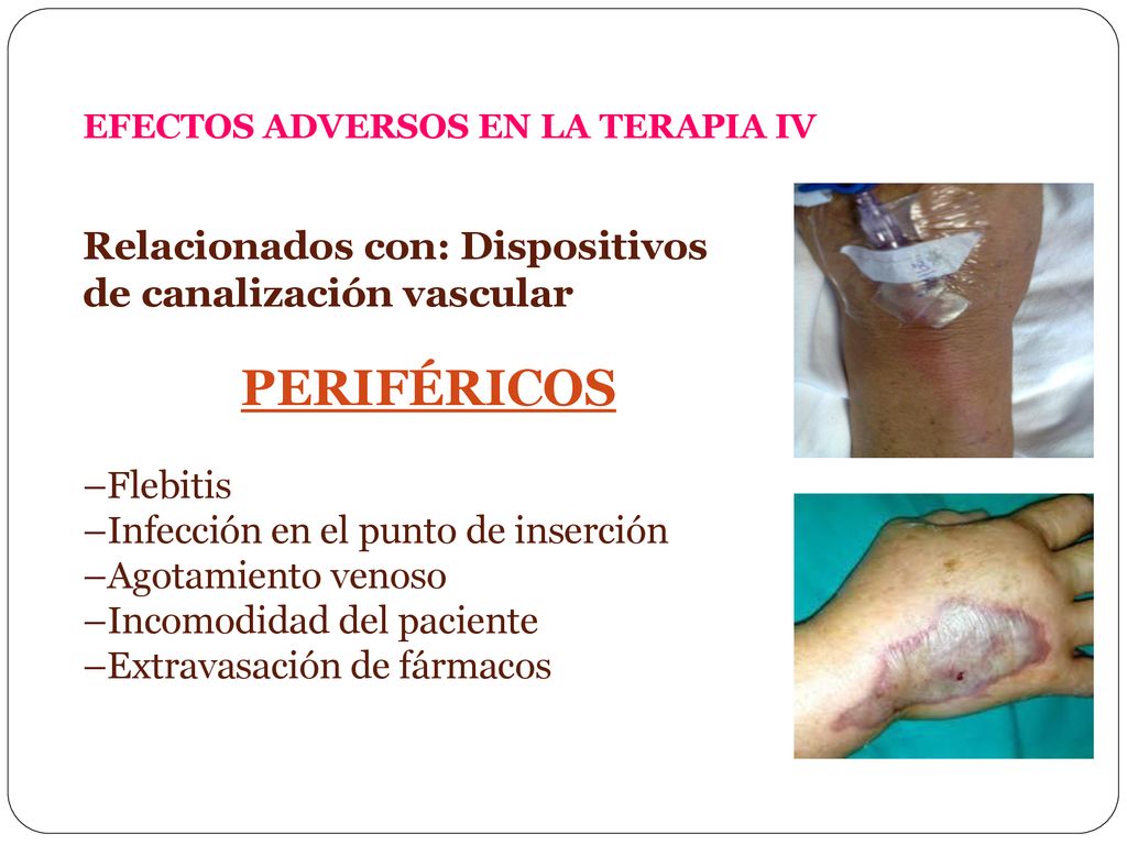 EFECTOS ADVERSOS EN LA TERAPIA IV Relacionados con: Dispositivos de canalización vascular PERIFÉRICOS –Flebitis –Infección en el punto de inserción –Agotamiento venoso –Incomodidad del paciente –Extravasación de fármacos